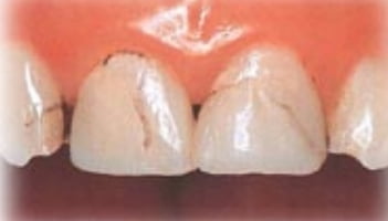 オールセラミック