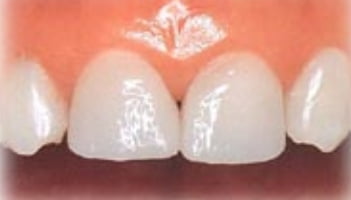 オールセラミック