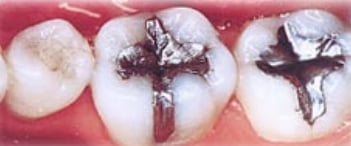 オールセラミック