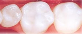 オールセラミック